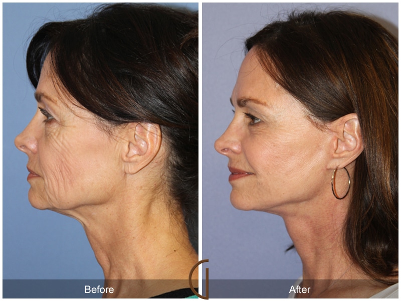 Facelift Anaheim CA 133 Image