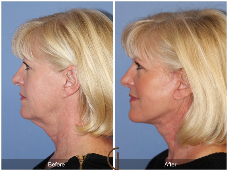 Facelift Garden Grove CA Image
