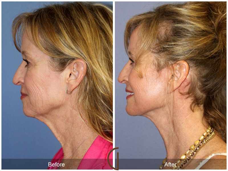 Facelift Beverly Hills Image