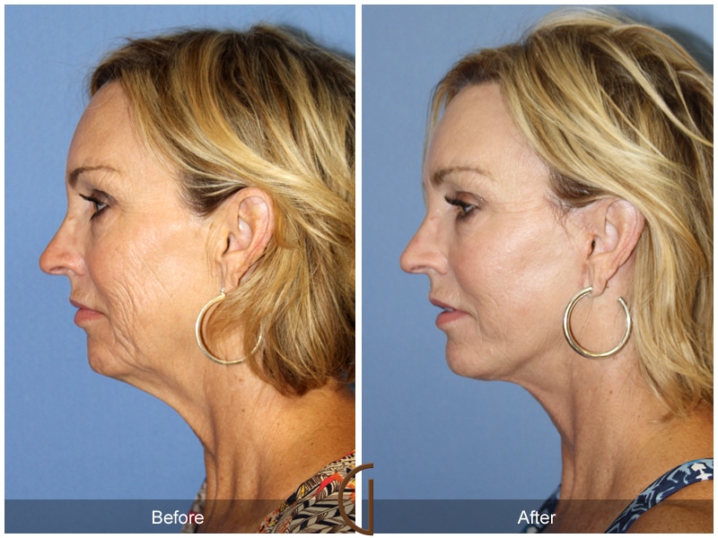 Facelift Santa Ana Image