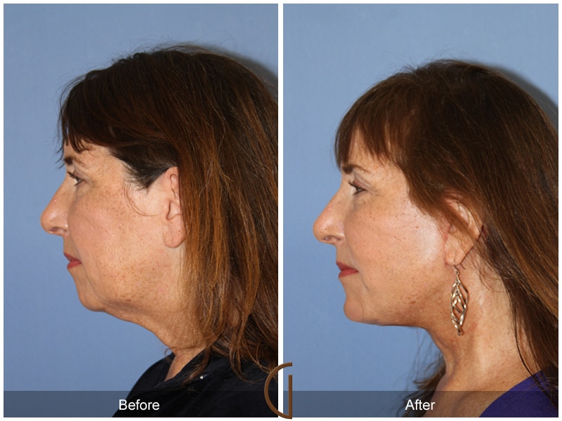 Facelift Laguna Woods CA 141 Image