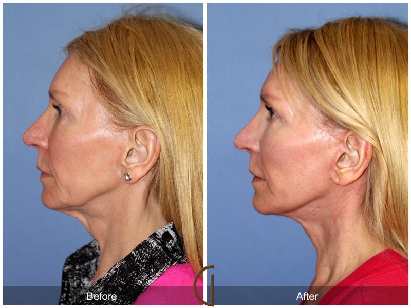 Facelift Manhattan Beach CA 146 Image