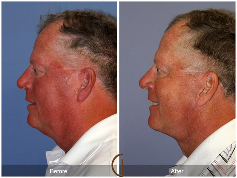 Facelift Topanga CA 153 Image