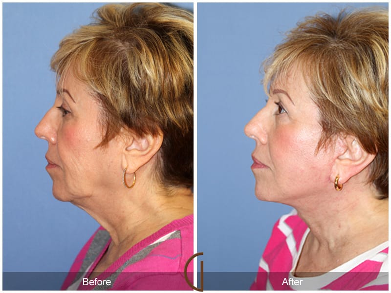 Facelift Bradbury CA 155 Image