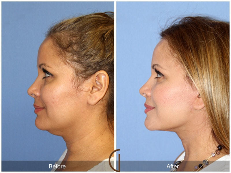 Facelift La Habra Heights CA 157 Image