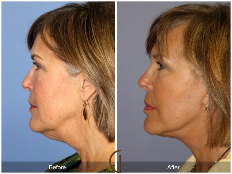 Facelift Eastvale CA 158 Image