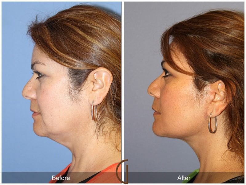 Facelift Castaic CA 160 Image