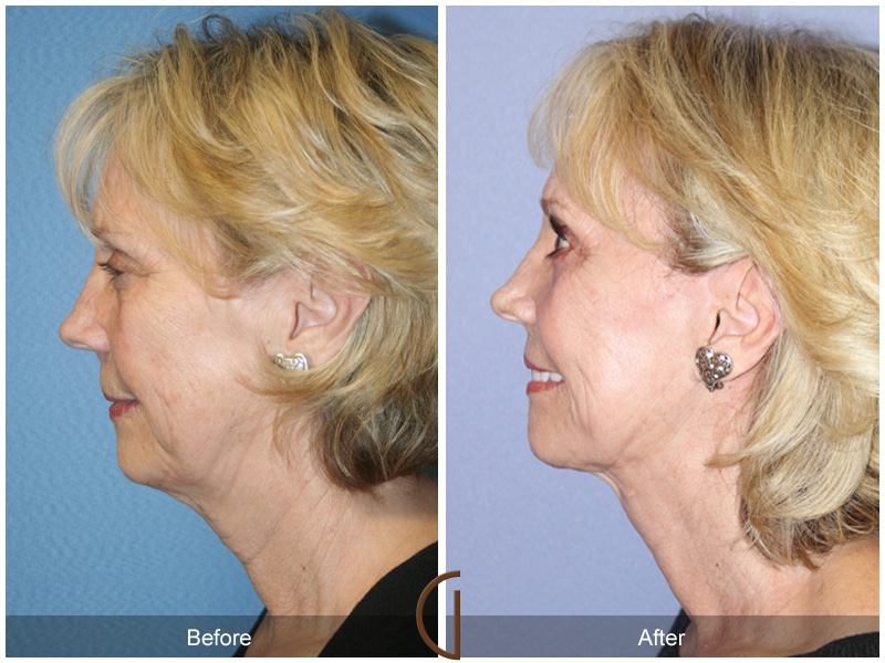 Facelift San Pasqual CA 163 Image