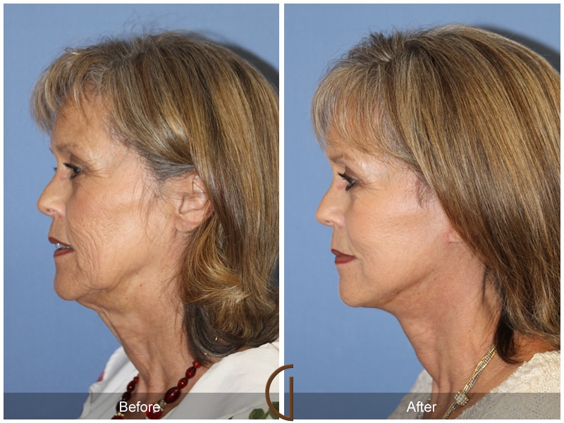Facelift Redondo Beach CA 164 Image