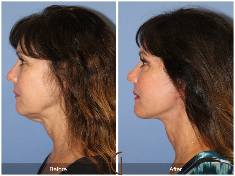Facelift Rancho Santa Fe CA 166 Image