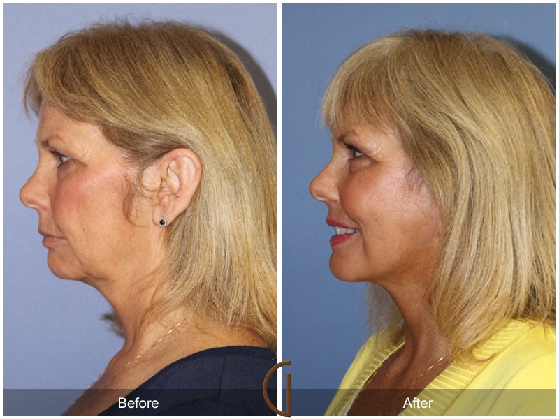 Facelift Rose Hills CA 173 Image
