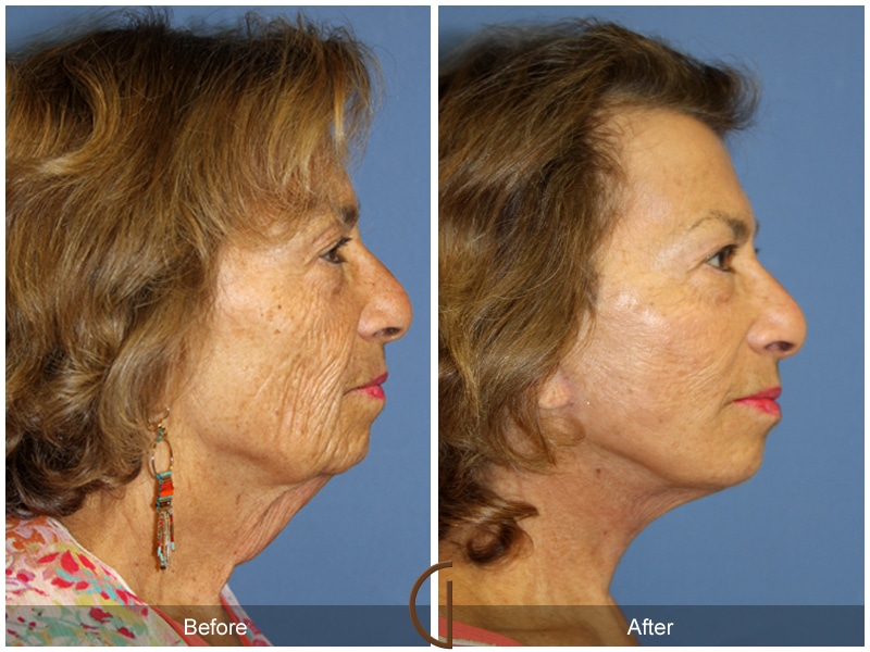 Facelift Cypress CA Image