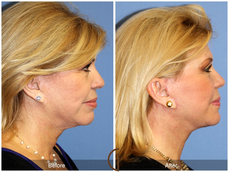 Facelift Huntington Beach CA 118 Image