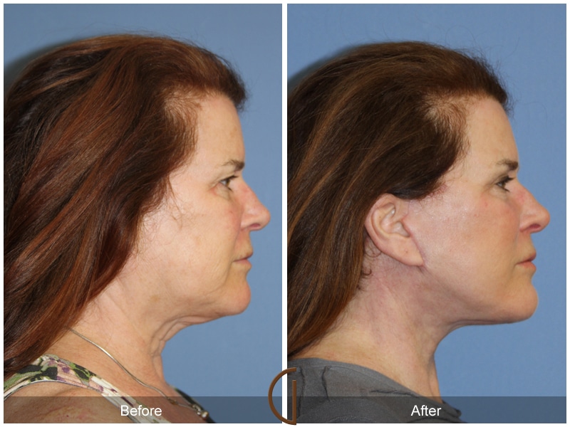 Facelift Placentia CA 121 Image