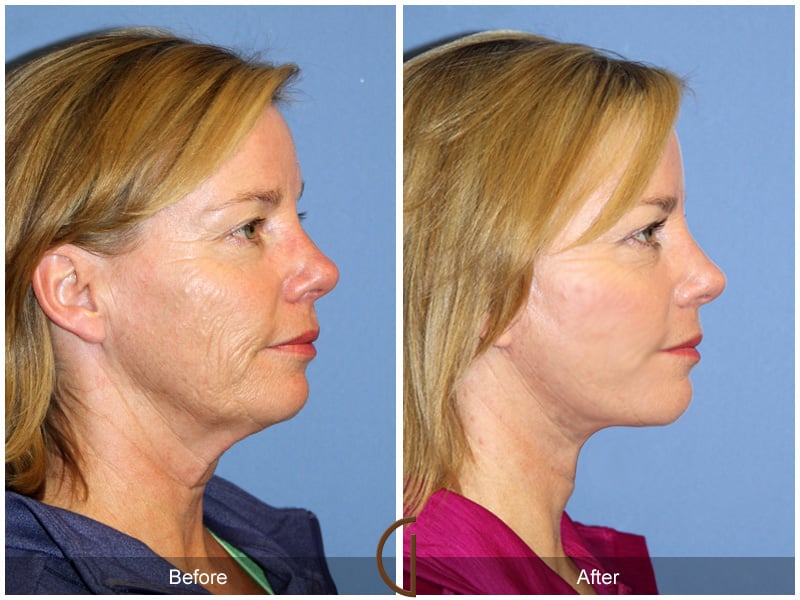 Facelift La Habra CA 132 Image