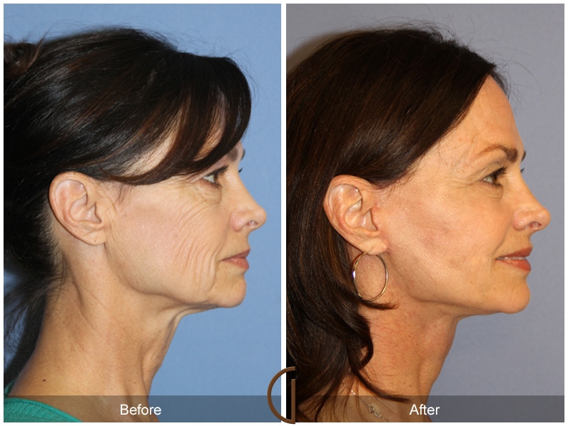 Facelift Anaheim CA 133 Image