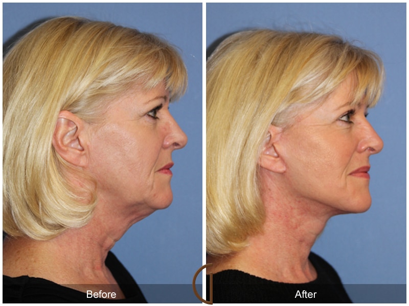 Facelift Garden Grove CA Image