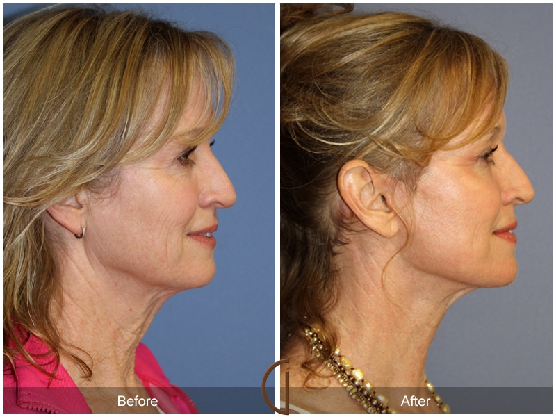 Facelift Beverly Hills Image