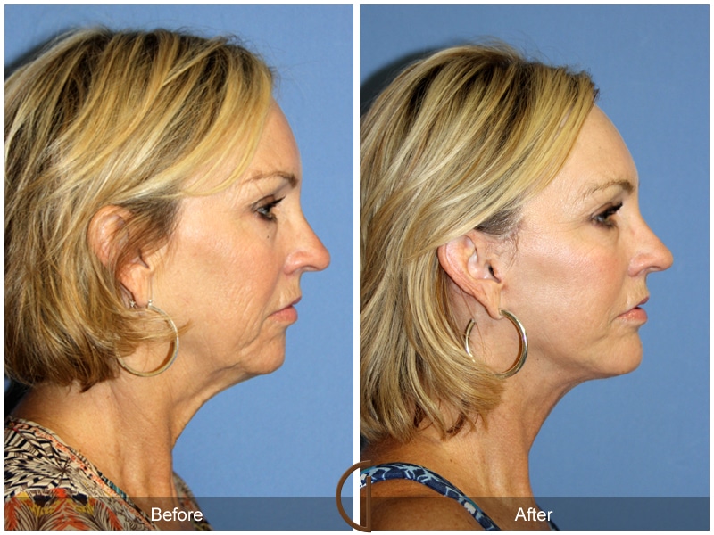 Facelift Santa Ana Image