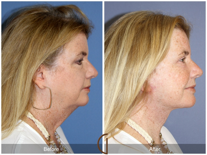 Facelift Anaheim Image