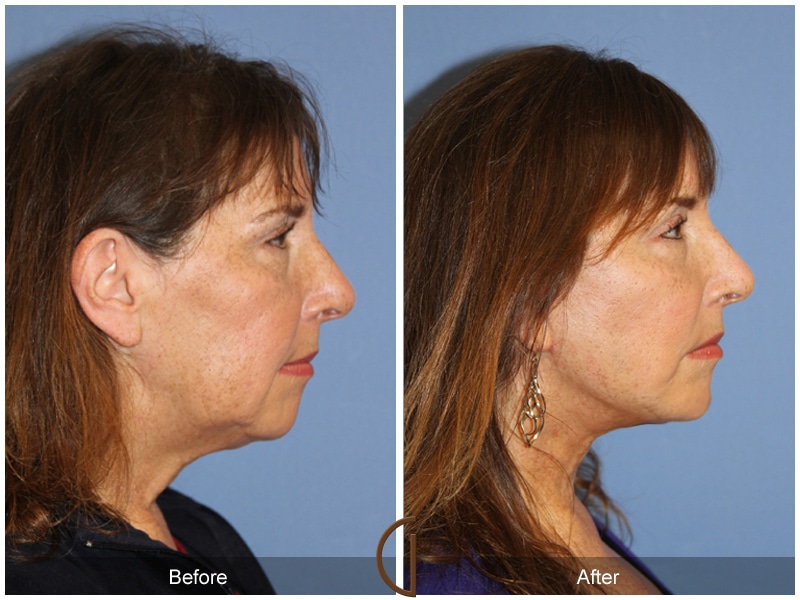 Facelift Laguna Woods CA 141 Image