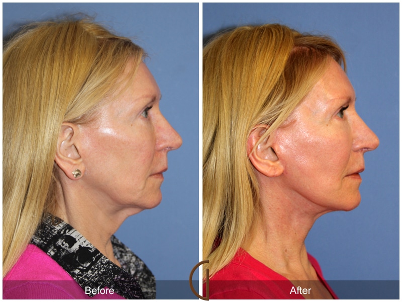 Facelift Manhattan Beach CA 146 Image