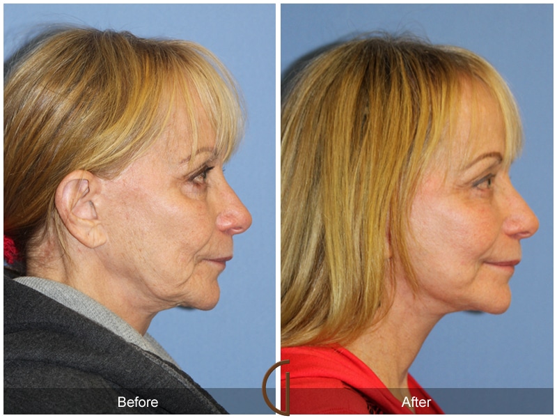 Facelift Rancho Palos Verdes CA 149 Image