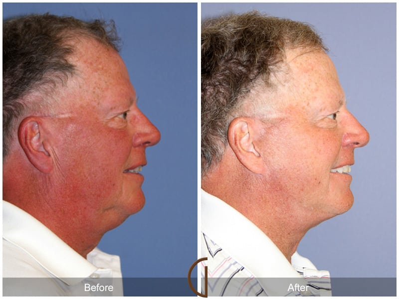 Facelift Topanga CA 153 Image