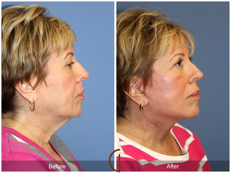 Facelift Bradbury CA 155 Image