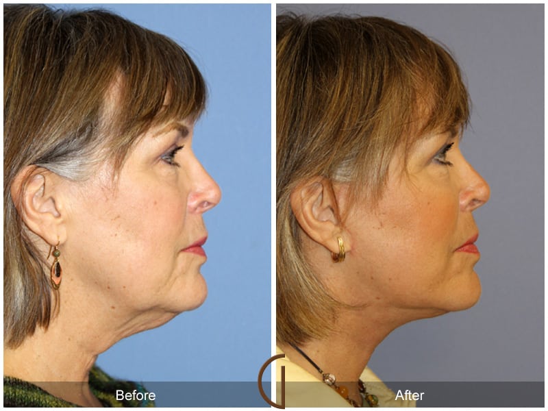 Facelift Eastvale CA 158 Image