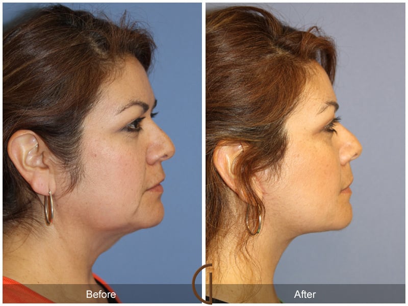 Facelift Castaic CA 160 Image