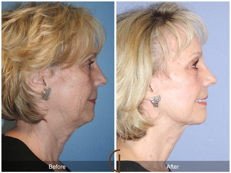 Facelift San Pasqual CA 163 Image