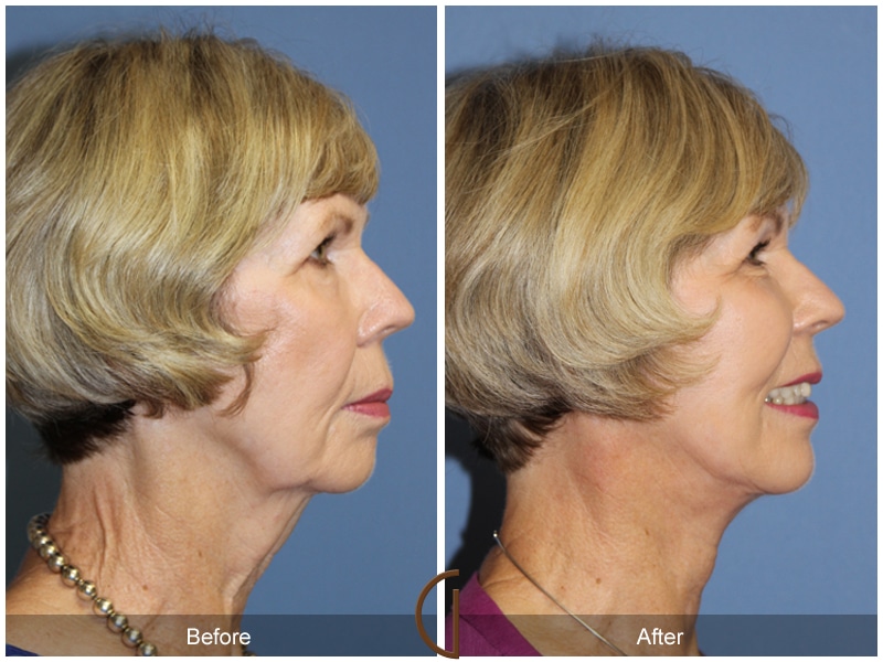 Facelift Marina del Rey CA 165 Image