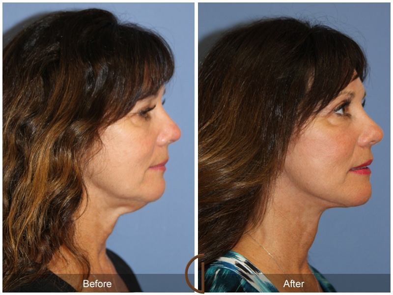 Facelift Rancho Santa Fe CA 166 Image