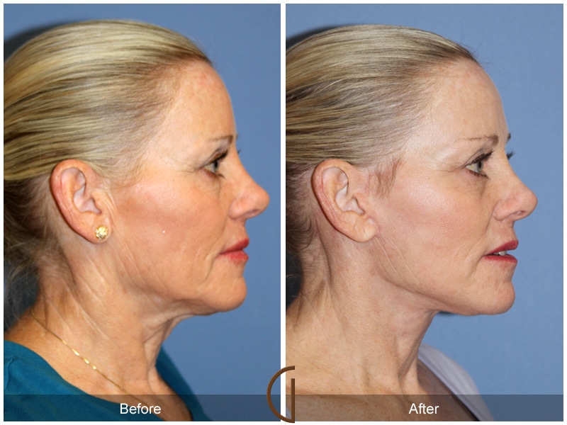 Facelift Walnut CA 168 Image