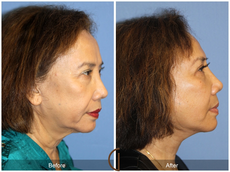 Facelift Pine Valley CA 170 Image