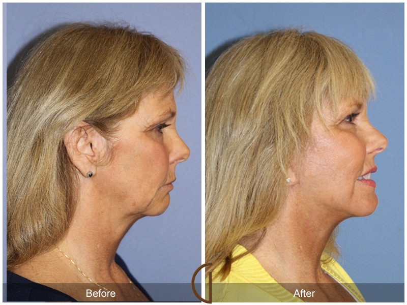 Facelift Rose Hills CA 173 Image