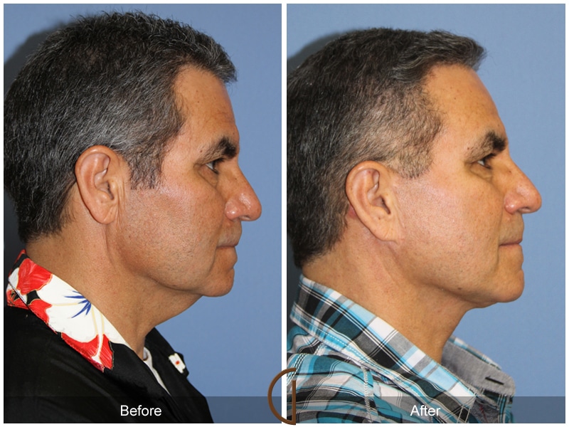 Facelift Santa Clarita CA Image