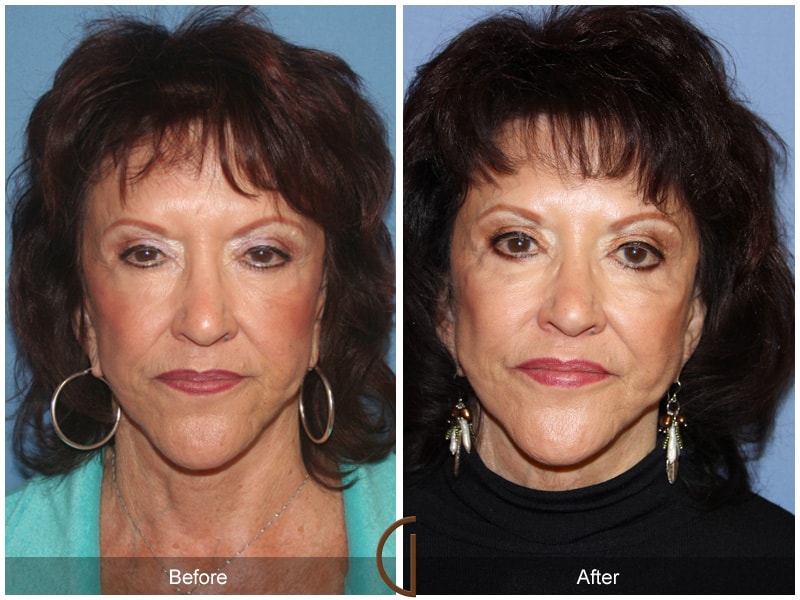 Facial Fat Grafting Cypress CA 11 Image