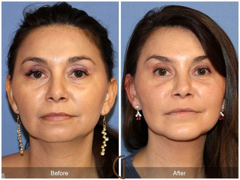 Facial Fat Grafting Mission Viejo CA 110 Image