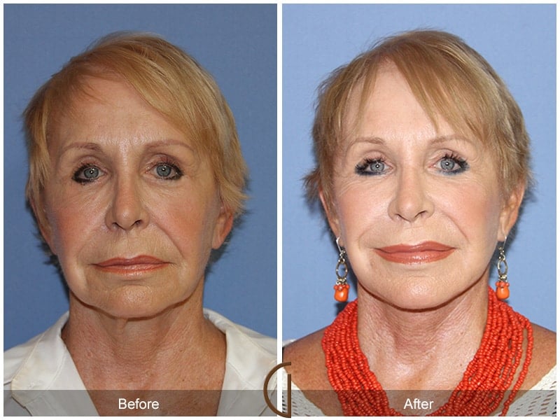 Facial Fat Grafting Huntington Beach CA 12 Image
