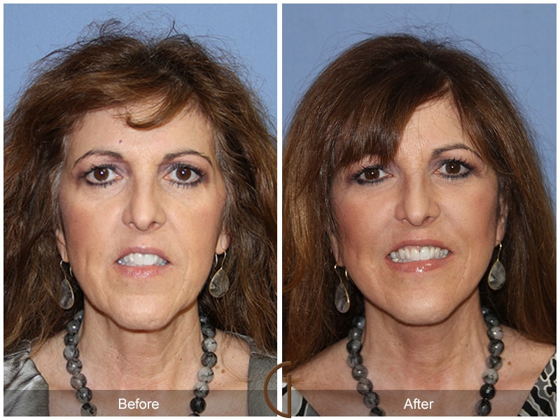 Facial Fat Grafting Brea CA 14 Image