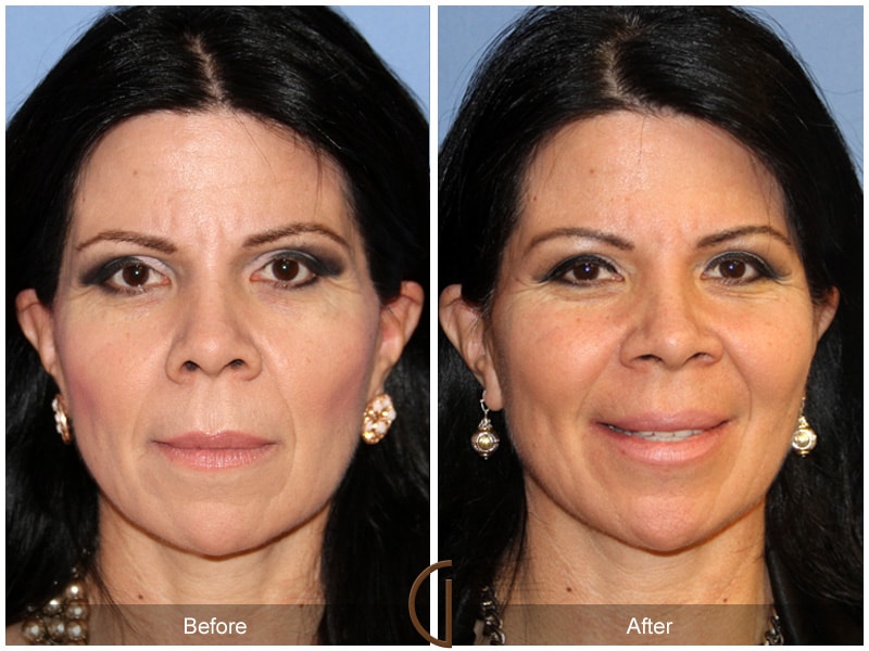 Facial Fat Grafting Placentia CA 15 Image