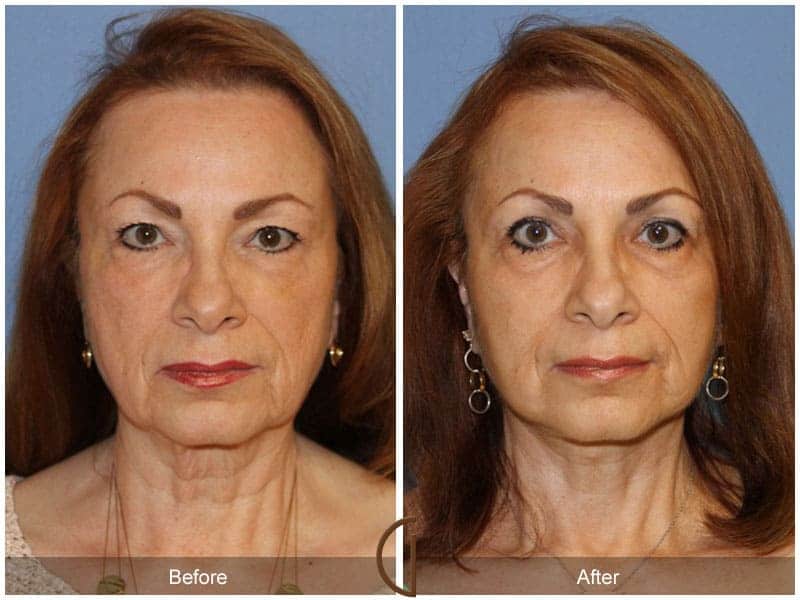 Facial Fat Grafting Irvine CA 4 Image