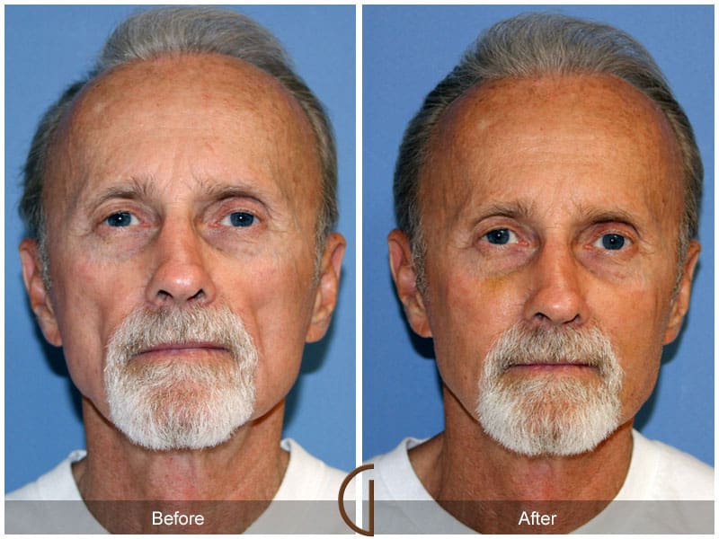 Facial Fat Grafting Laguna Hills CA 6 Image