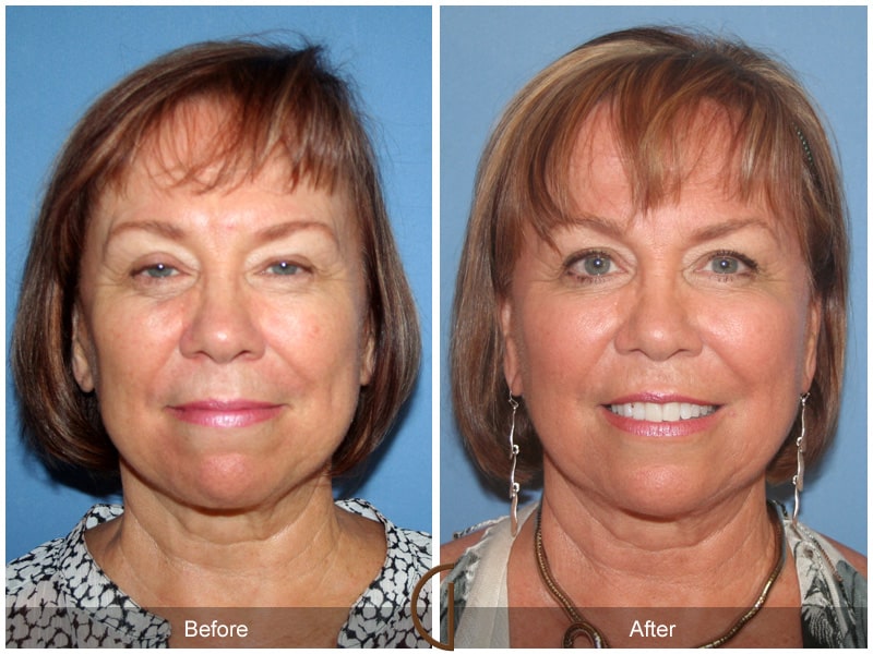 Facial Fat Grafting Dana Point CA 7 Image
