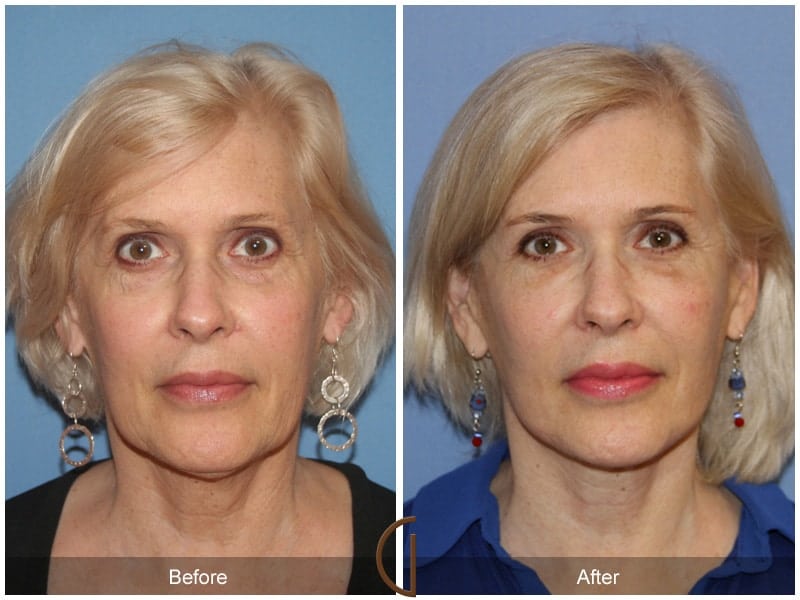 Facial Fat Grafting La Palma CA 9 Image