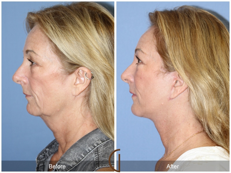 Facial Fat Grafting Fullerton CA 47 Image