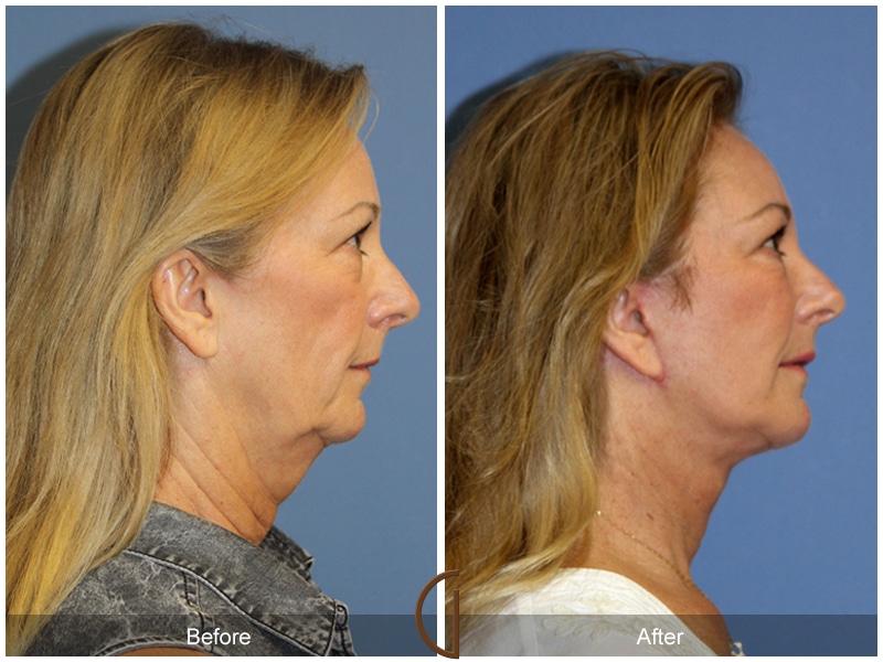 Facial Fat Grafting Fullerton CA 47 Image