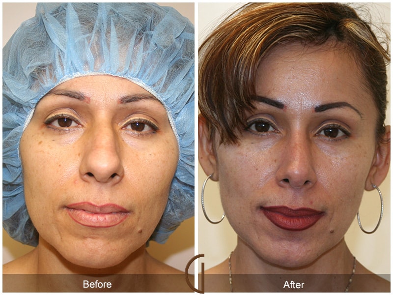Ethnic Rhinoplasty Orange County CA 13 Image